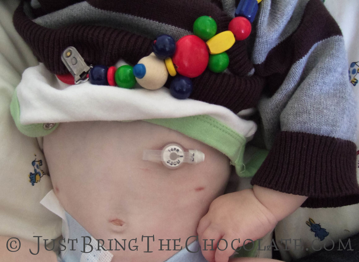 The Gastrostomy Feeding Tube (G tube or PEG)